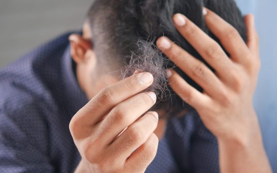 A man runs his left hand through his hair while holding tuft of hair that has fallen out with his right hand.